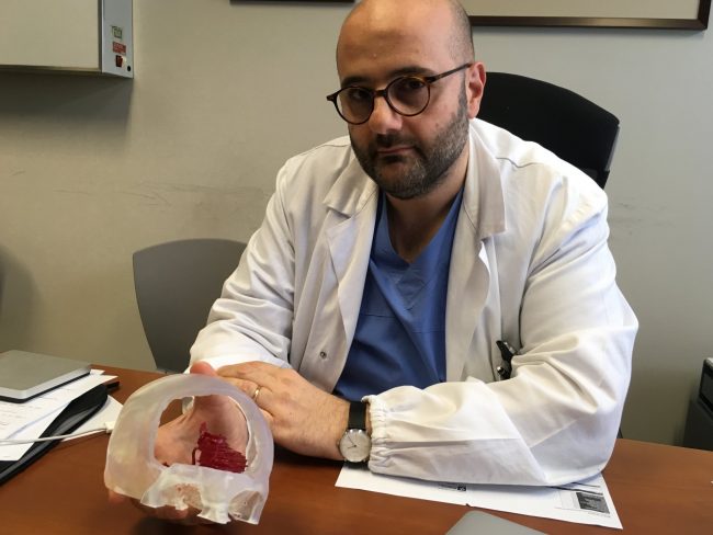 Operazione da record al Manzoni: salvato un paziente con un aneurisma gigante